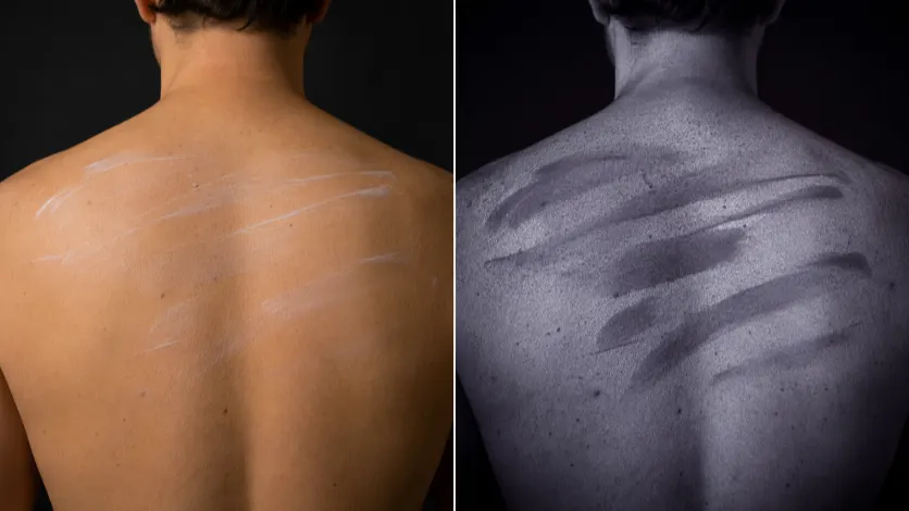 Side-by-side visible-light and ultraviolet photographs of a person's back with SPF 30 sunscreen applied.